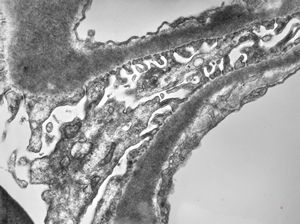 M,29y. | type II membranoproliferative glomerulonephritis (dense deposit disease)